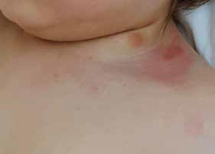 Objawy mastocytomy u psów