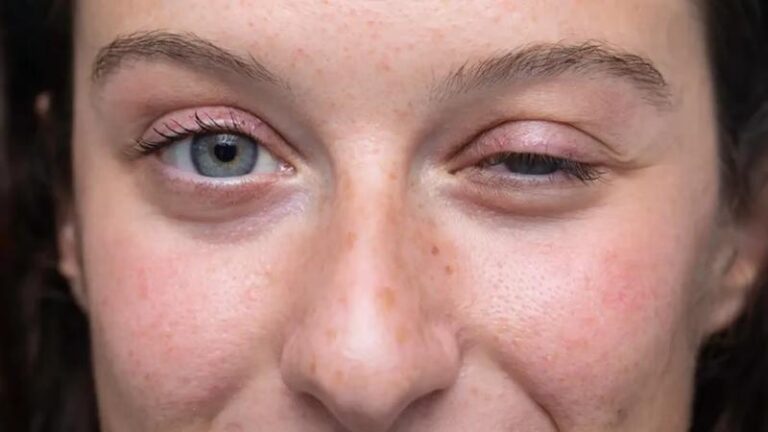 Zanik mięśni u psa: objawy, przyczyny i skuteczne metody leczenia miastenii